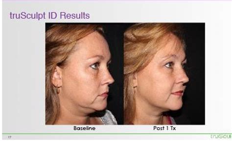 trusculpt id near me